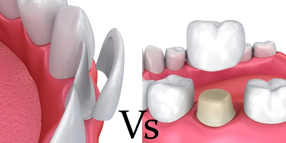 Dental crowns: materials, stages and costs