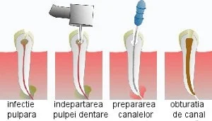 Toothache: causes and treatment