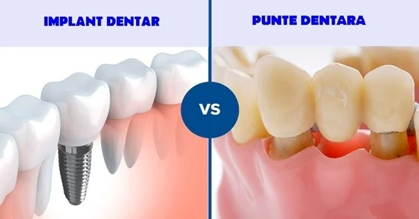 Dental crowns: materials, stages and costs