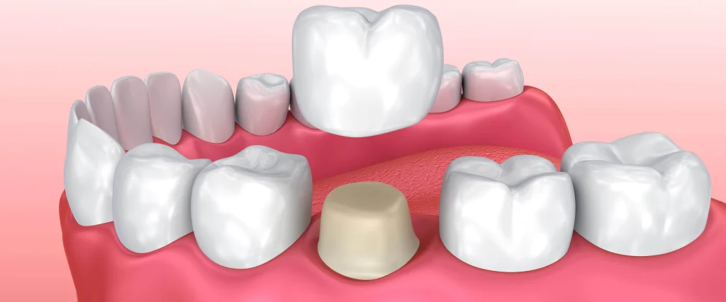 Dental crowns: materials, stages and costs