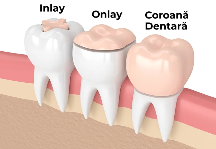 Cosmetic dentistry: veneers and crowns