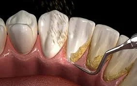 Periodontitis and oral health investigations