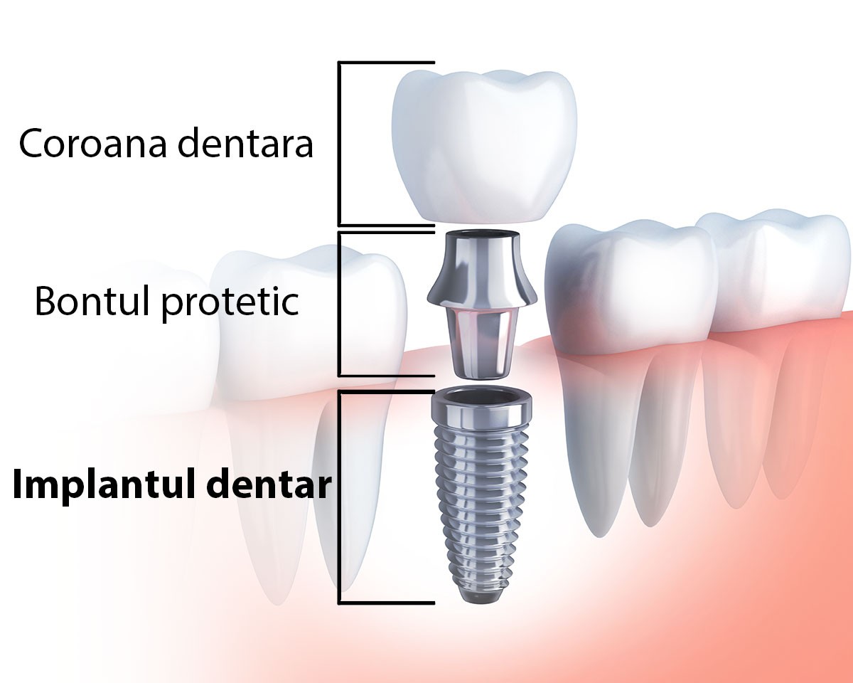 structura implantului dentar